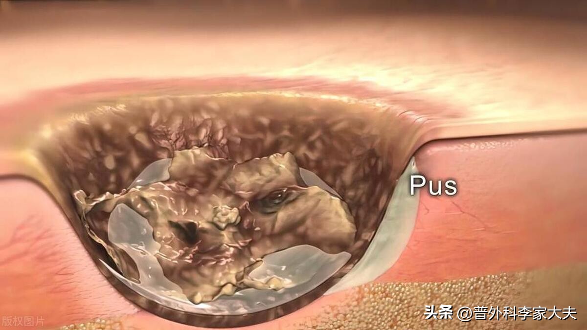 伤口感染原因,伤口感染导致骨头感染