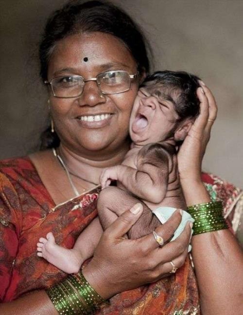 故事:非洲17岁女孩长满络腮胡,毛发从鼻孔长到脖子,身体有何异常