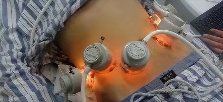 白癜风能去掉白斑吗,白癜风能不能去把皮肤刺破