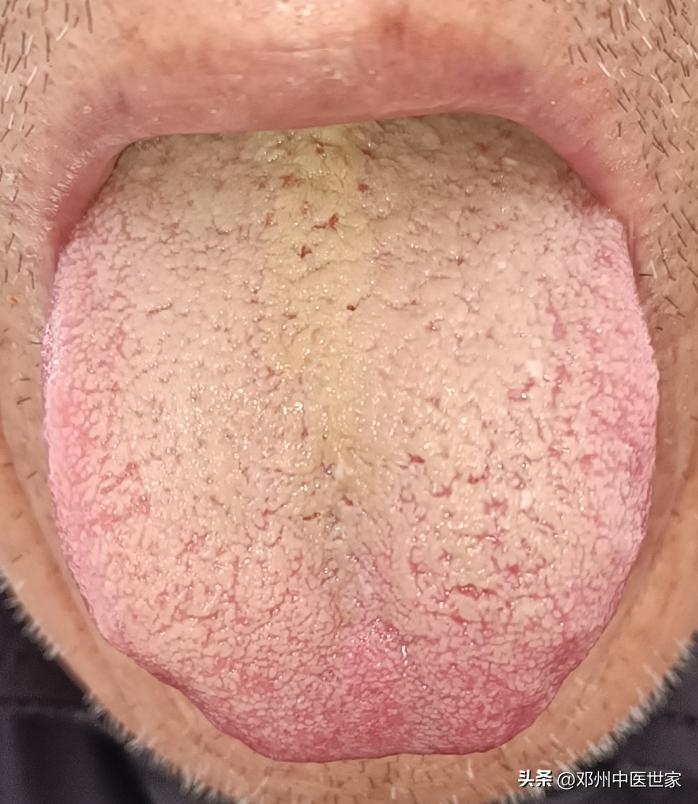 中药治疗前列腺增生前十名医院,中药治疗前列腺增生效果如何