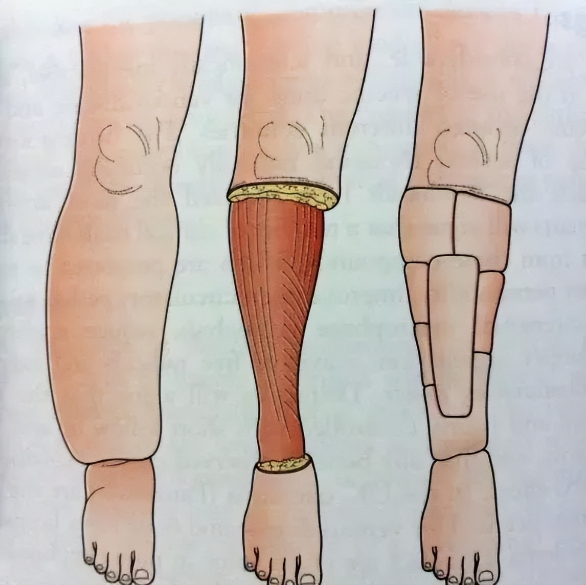发现|继发性淋巴水肿的潜在治疗靶点及药物