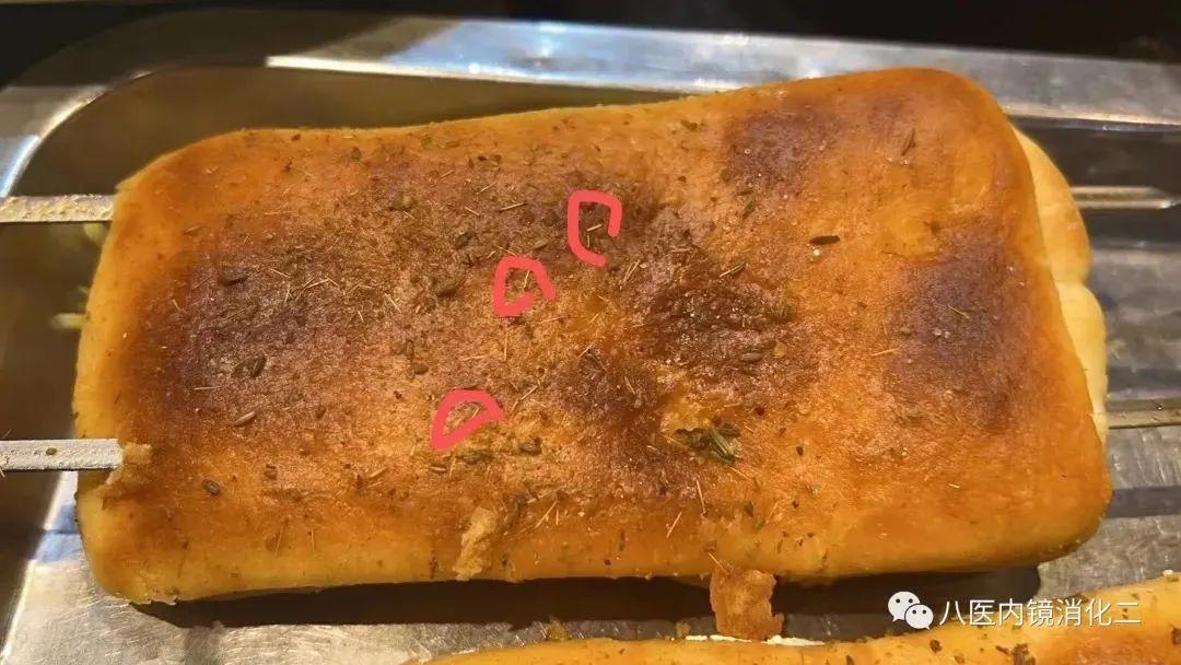 鱼刺卡喉两个月竟然没有发现,鱼刺卡喉半年险些酿成大祸