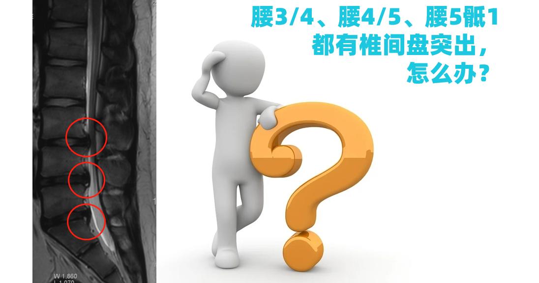 腰4-5及腰5骶1椎间盘突出多久会好,腰4-5及腰5骶1椎间盘突出怎么缓解