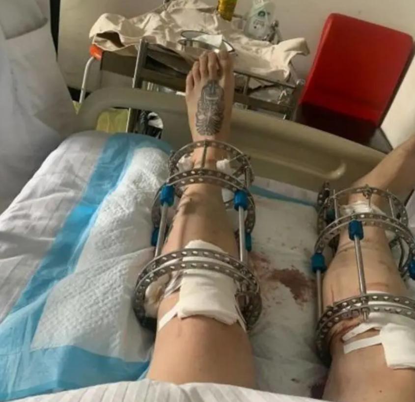 李亚诺中国断骨增高第一人,当年花16万断腿增高