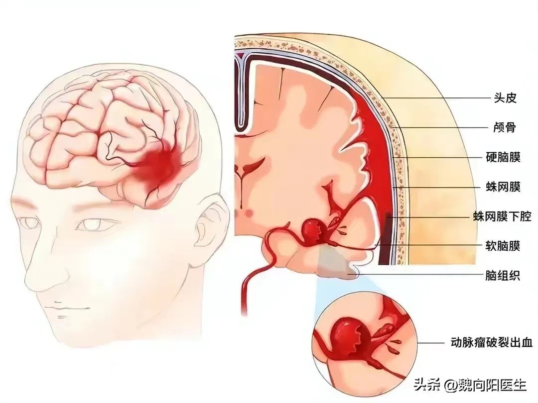发现颅内动脉瘤究竟要不要手术,颅内动脉瘤是什么原因引起的