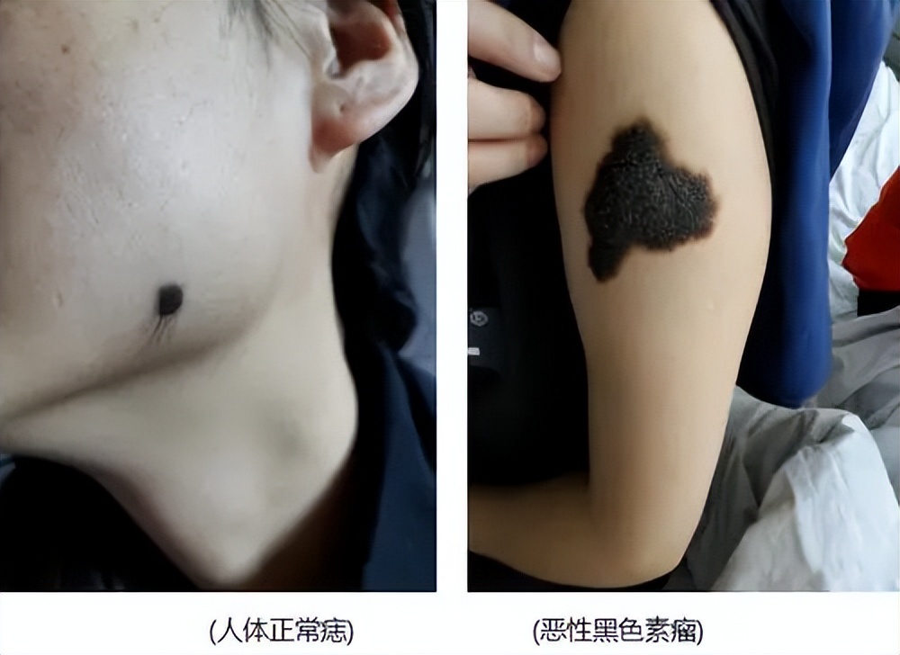 男子长了1000个鸡眼,58岁男性脚底长了一个包一碰就疼