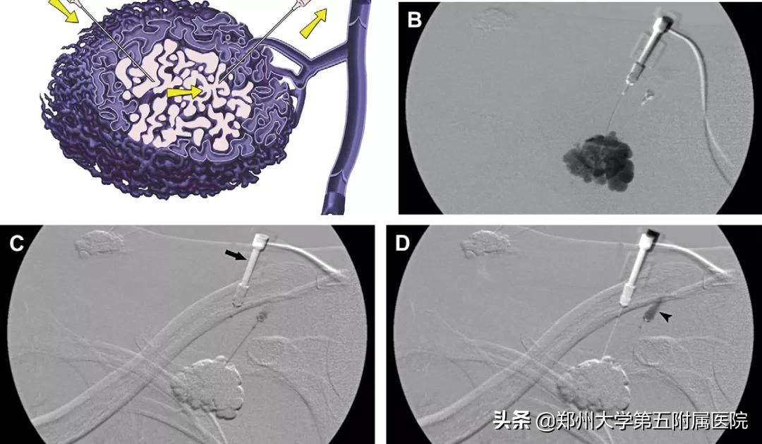 健康科普治疗结节,静脉畸形有硬肿块要做手术吗