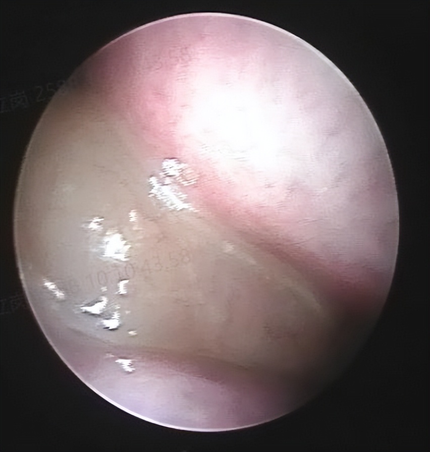 反复鼻塞,好不了,这次总算找到了原因
