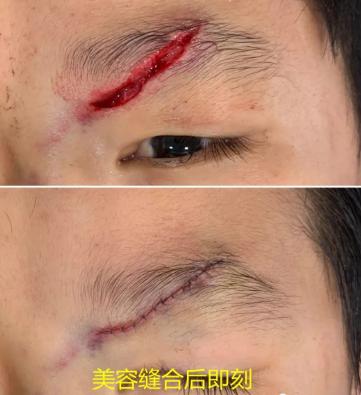 大面积外伤疤痕怎么修复,面部手术留下的蜈蚣疤痕怎么修复