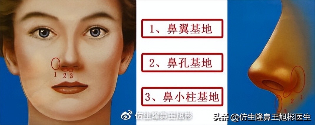 隆鼻鼻型科普,鼻基底凹陷隆鼻可以改善吗
