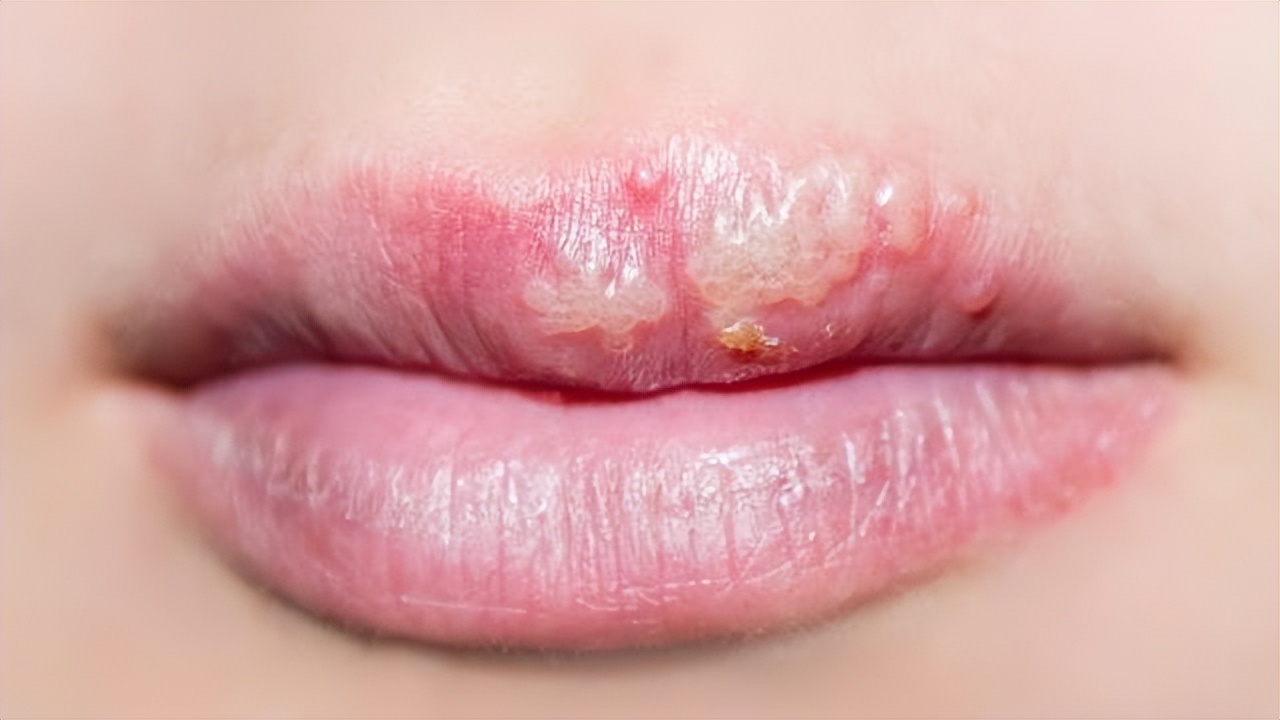 嘴上出了好多透明水泡会传染吗,嘴巴周围长了好多小水泡要忌口吗