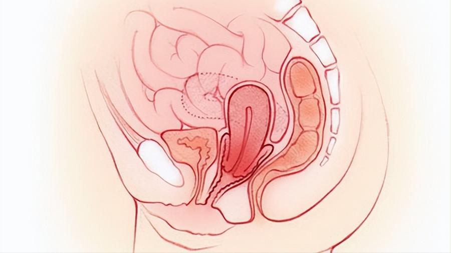 女人的子宫往下掉怎么治疗,女人老了子宫脱落的症状