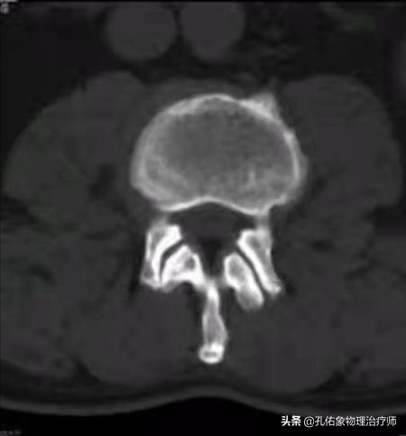 腰椎管狭窄引起的腰腿疼怎么办,腰椎管狭窄引起腰痛腿痛怎么办