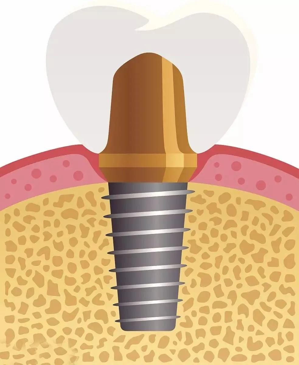 为什么种牙之前要做牙ct,牙周病可以直接把牙齿拔掉种牙吗