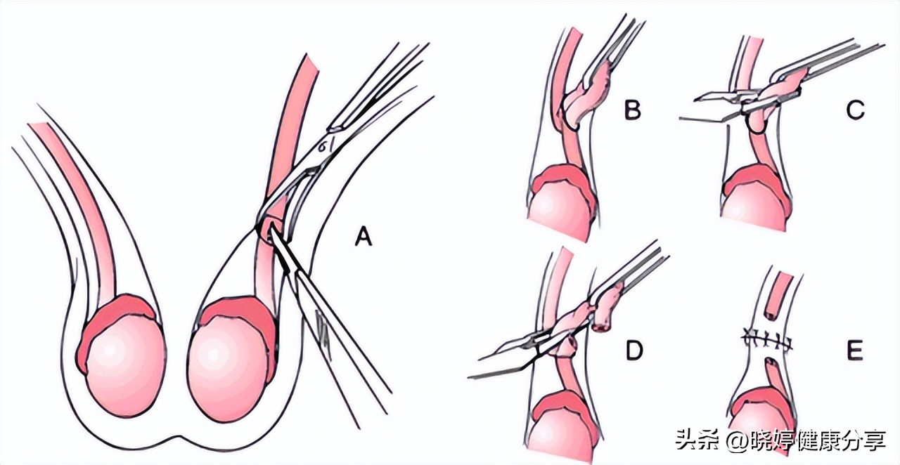 输精管结扎后要做的6件事很快就会恢复