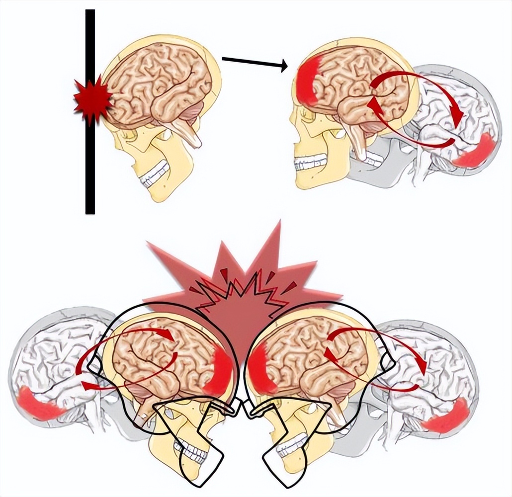 撞到后脑勺了要注意什么,撞到头要注意哪些事项