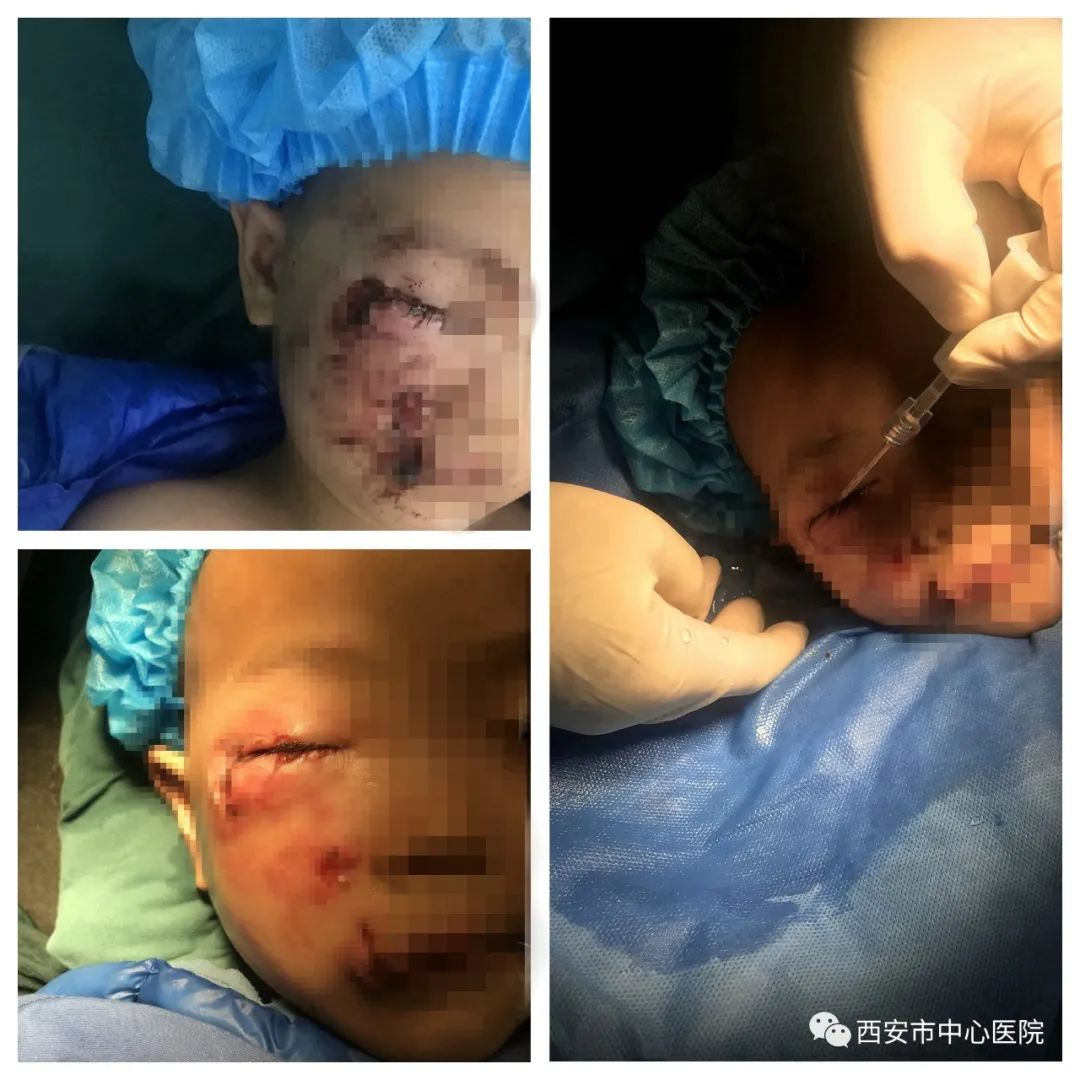 三岁男童遭狗咬伤后不幸离世,3岁孩子被狗咬伤后死亡