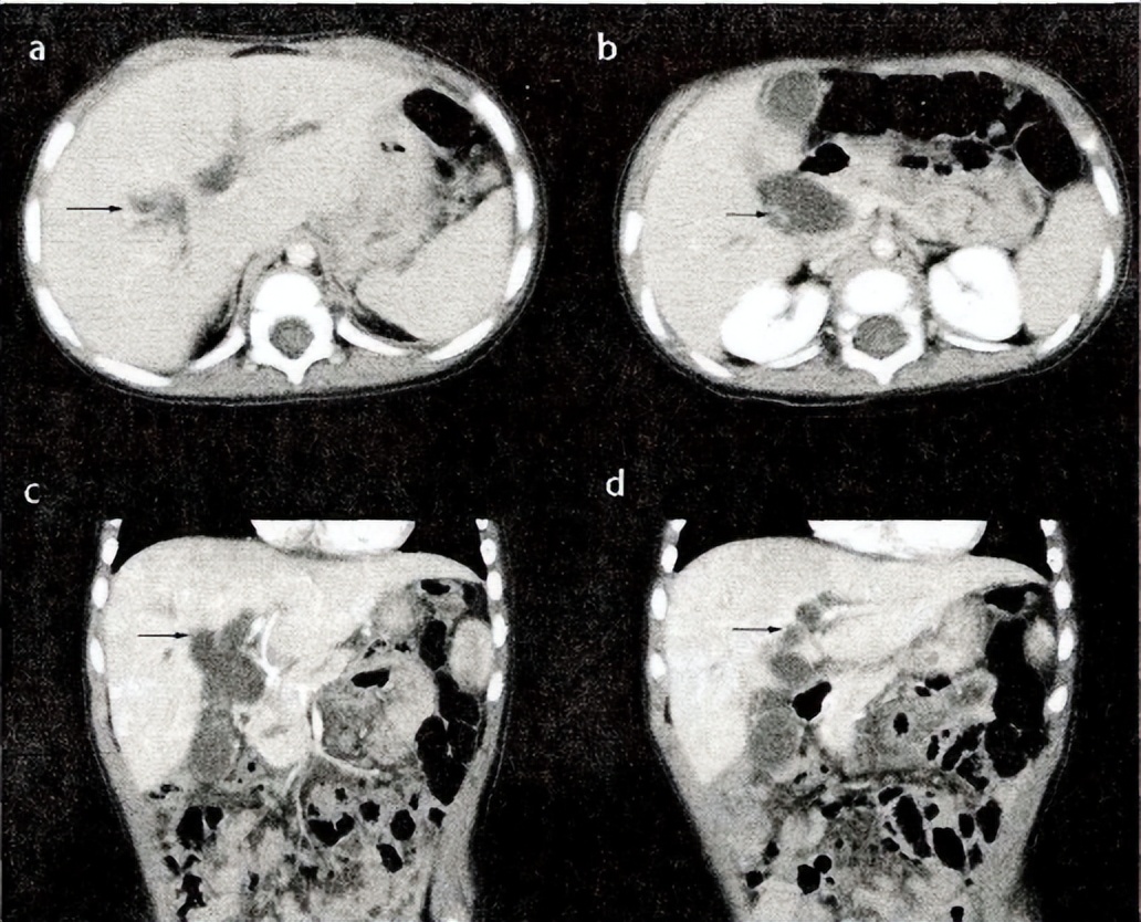 胰胆管合流异常影像诊断,基于影像组学的深度学习