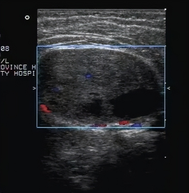 腋窝包块超声鉴别诊断,腋窝淋巴结检查法