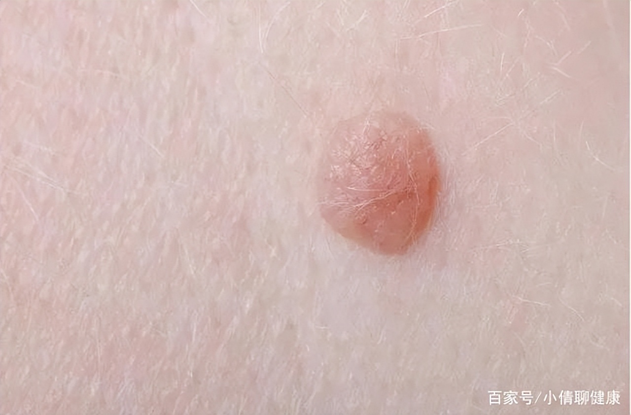 脖子腋下的小肉粒是什么,脖子上肉粒可以自己揪掉么