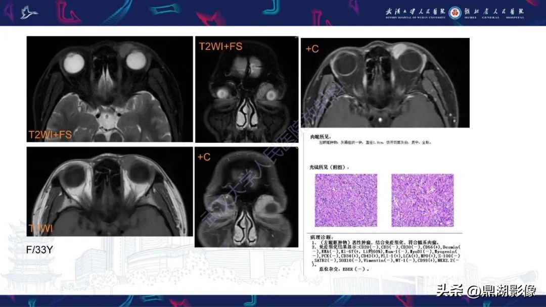 阴道肉瘤的早期症状,阴道里长肉瘤是啥症状
