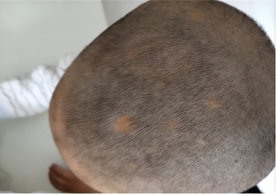 头皮上摸到一个硬疙瘩,头皮有小疙瘩摸着疼怎么回事