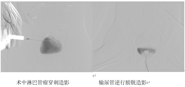 儿童腹腔淋巴管瘤介入微创治疗病例