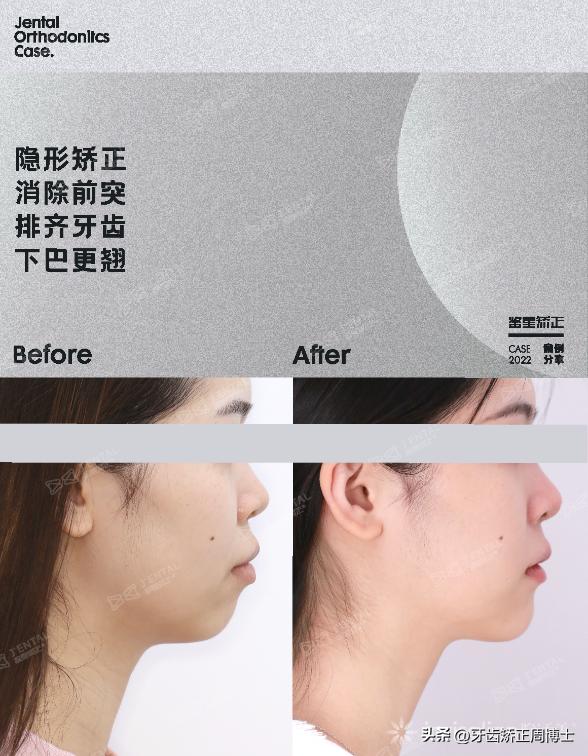 隐形矫正龅牙效果图,严重龅牙可以用隐形矫正吗