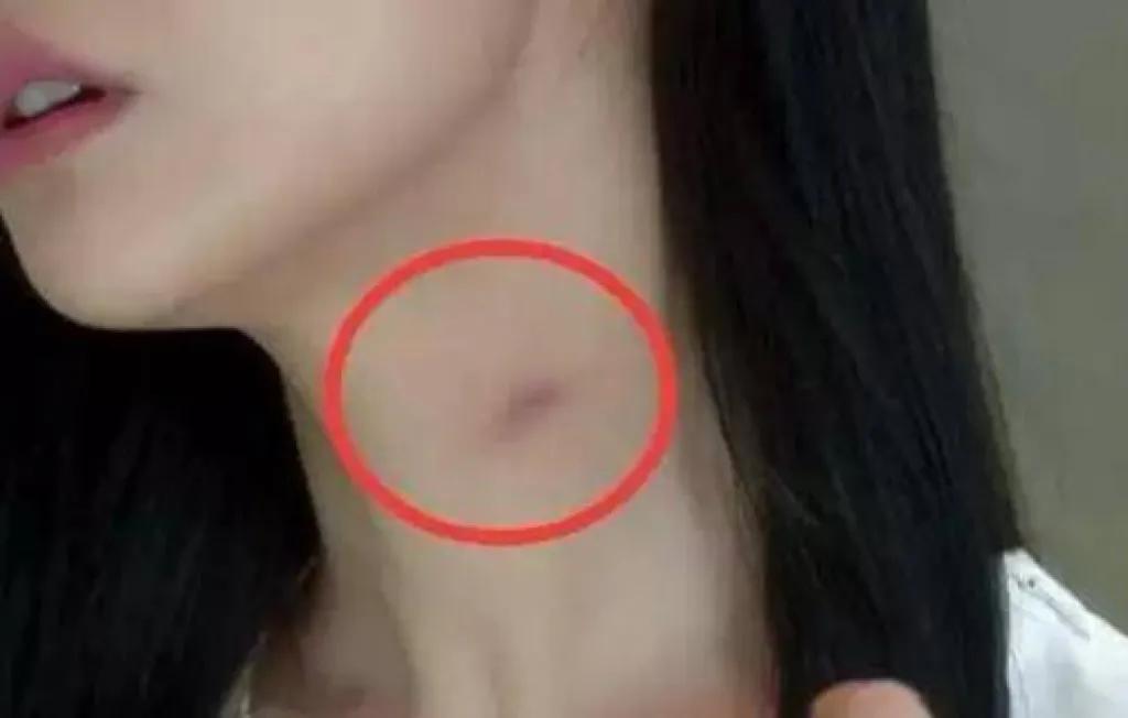 被女友留吻痕丧命,女友在男友脖子上留痕迹