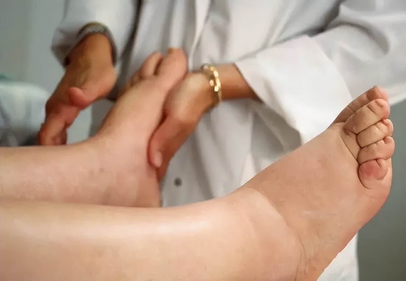 孕晚期腿脚水肿是什么原因造成的,孕初期脸肿了是怎么回事