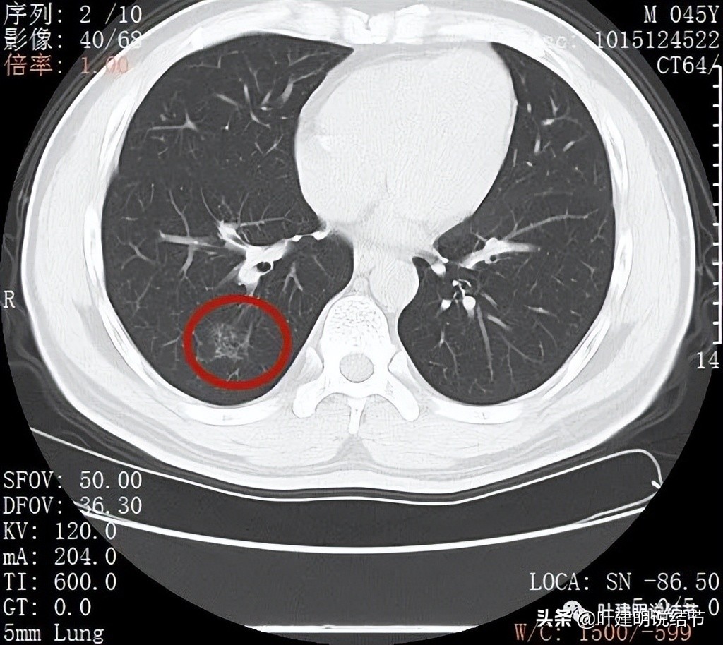 误诊肺纤维化,肺蜂窝状是癌吗