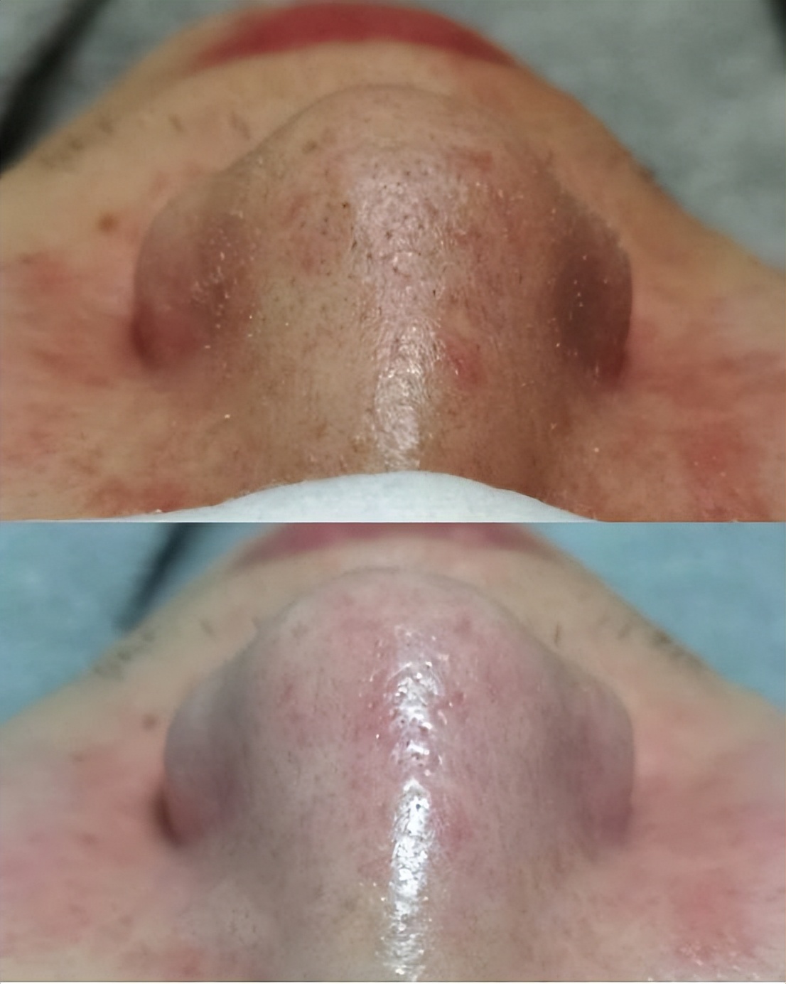 去除鼻子黑头收缩毛孔小妙招,鼻子黑头毛孔大抹什么药膏