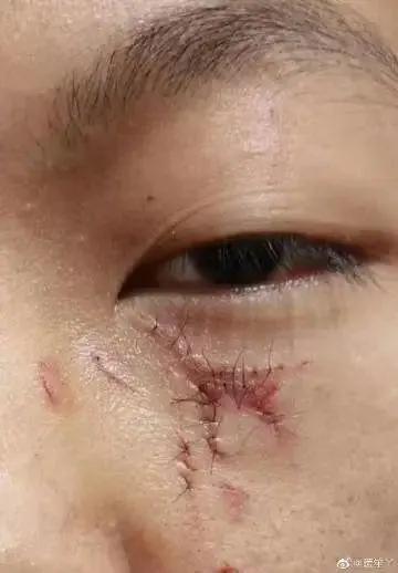 榆林小学生被老师踢伤,小学生被老师打了身上两处淤青