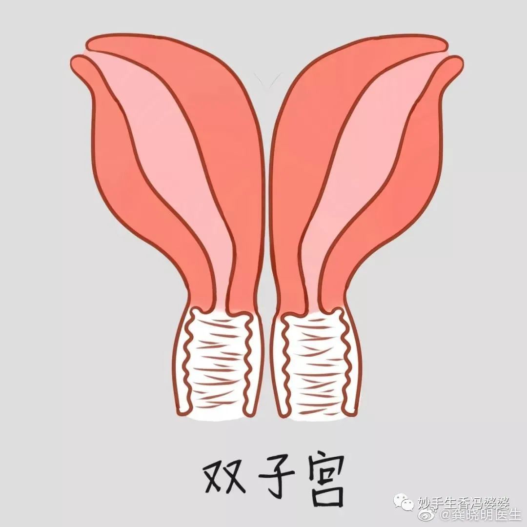 子宫畸形造成的胎停好治疗吗,子宫畸形是不是没法生孩子了