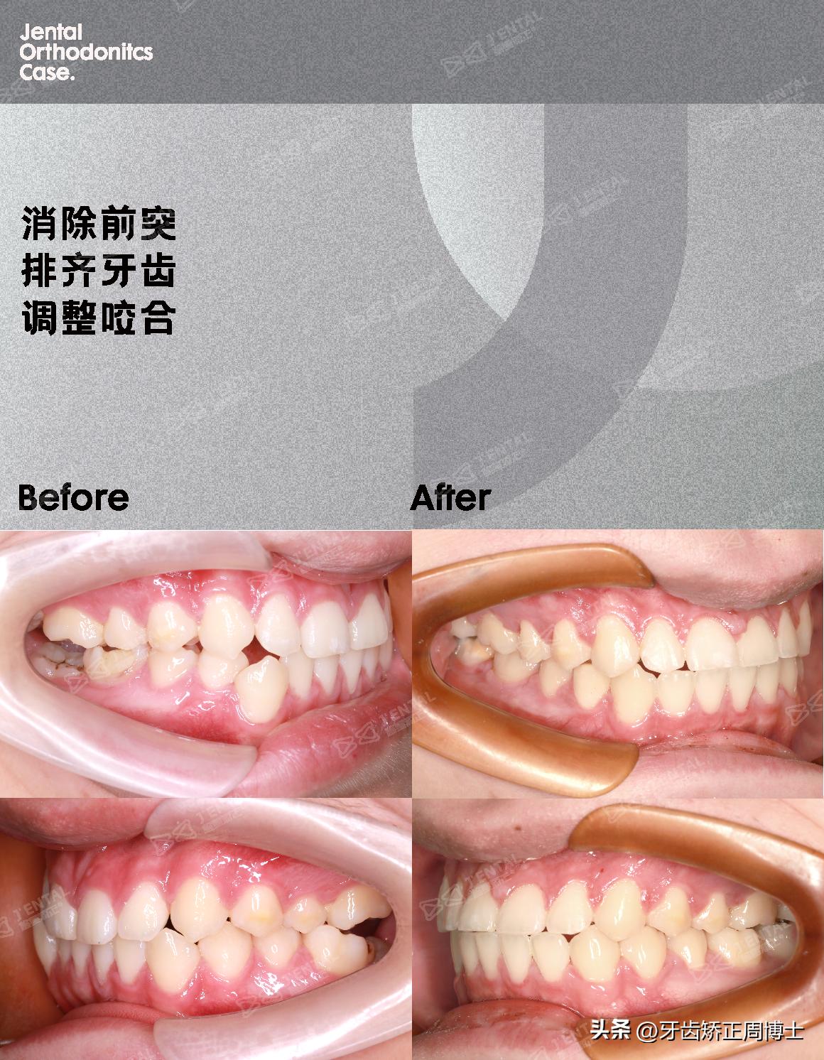 小孩牙齿为什么迟迟不长,孩子牙齿刚长出来不齐怎么办