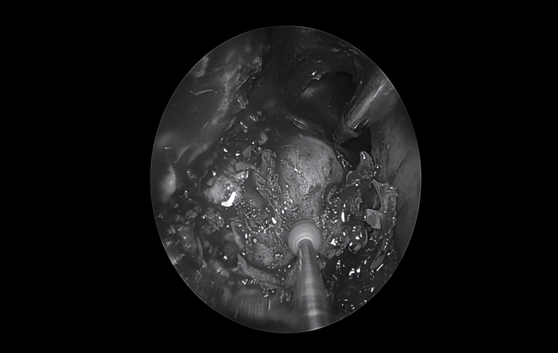 南昌二附院耳鼻喉科手术,南昌大学第二附属医院耳鼻咽喉科
