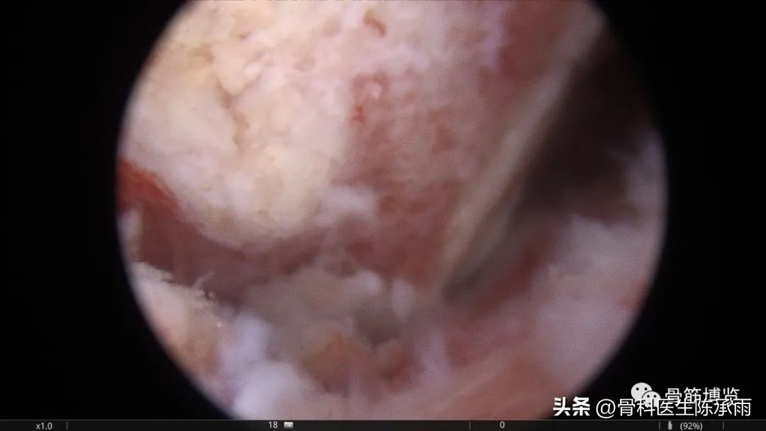 化脓性关节炎的穿刺引流治疗,关节炎镜下治疗