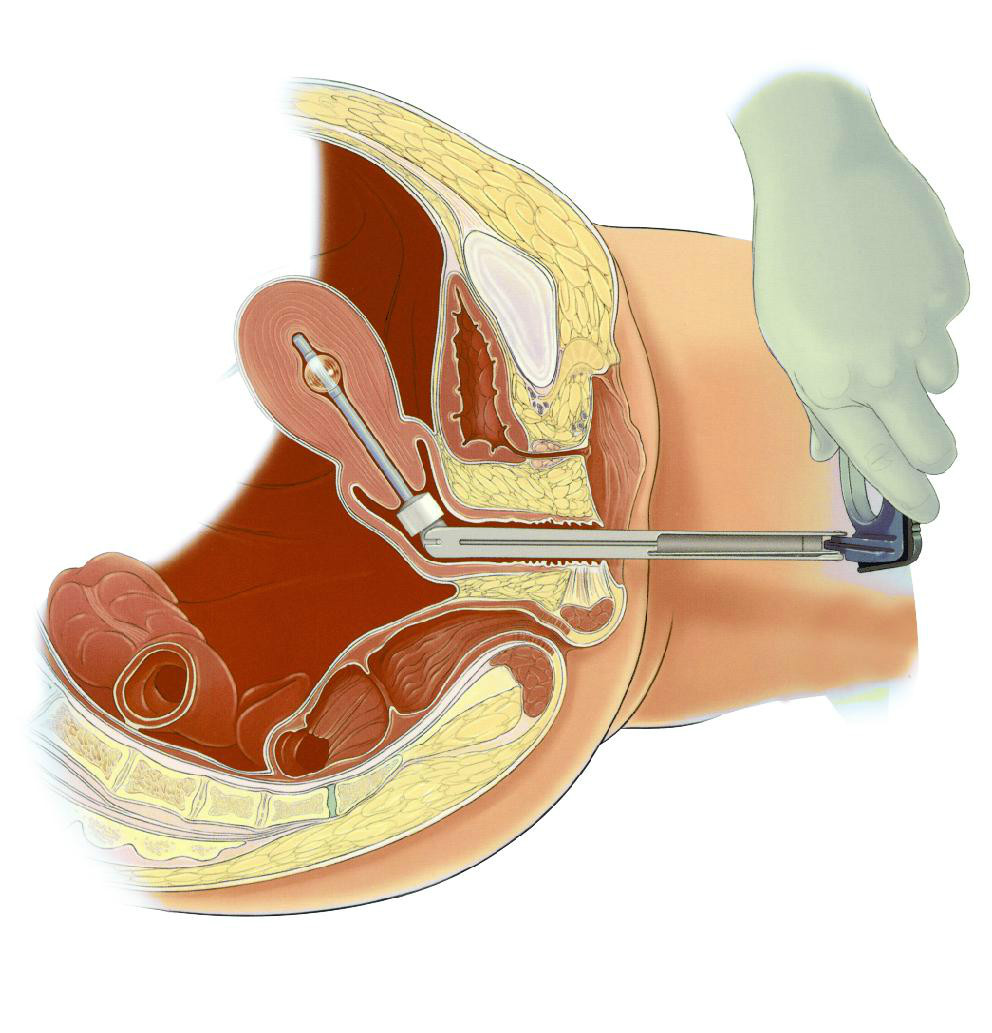 单孔腹腔镜不适合哪些妇科手术,妇科单孔腹腔镜