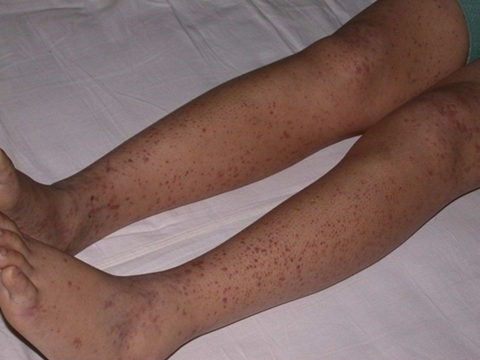 身上出现小红点，是血癌？医生：宝宝皮肤出现这3种异常，要当心