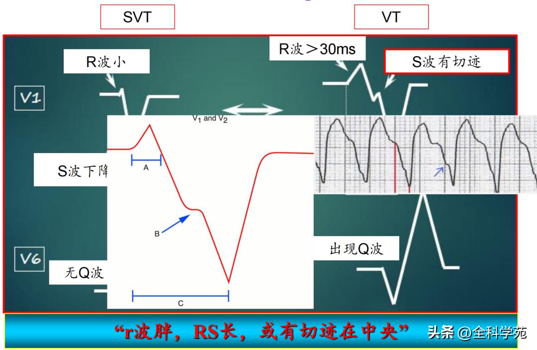 心电图上表现为宽qrs波,心电图中qrs是代表心动过速吗