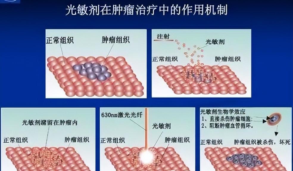 宫颈湿疣激光治疗是怎样的,宫颈尖锐性湿疣用干扰素会好吗