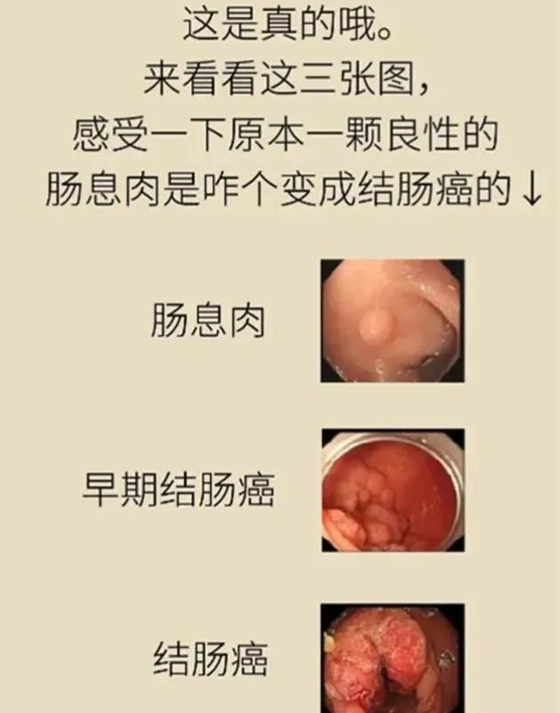 肠长了息肉有什么症状,肠里有息肉是怎么造成的