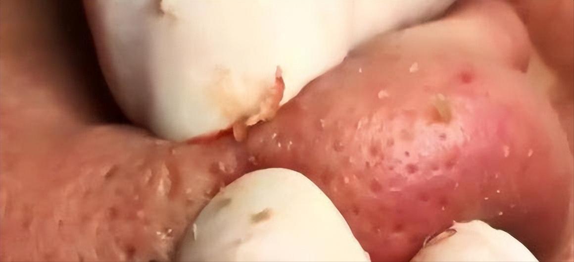 鼻子黑头里挤出的白色油脂怎么办,鼻子上有硬硬的黑头怎么办