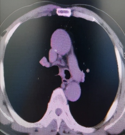 哈医大一院气管镜,哈医大群力呼吸内科