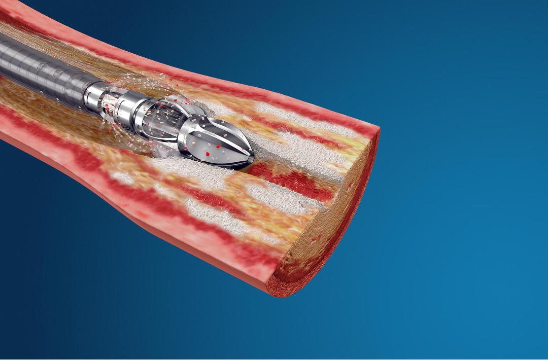 医疗器械带量采购最新官方消息,预防类医疗器械