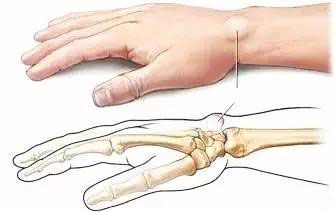 鼠标手腕管综合征挂什么科,白领鼠标手腕管综合征