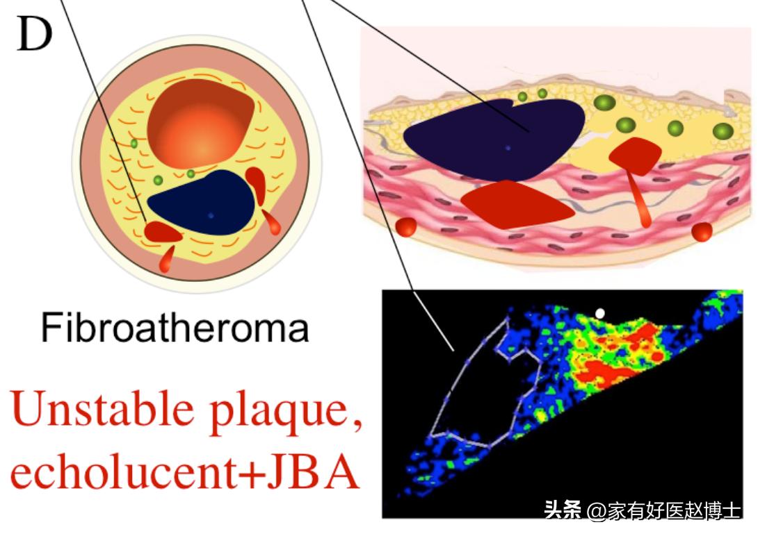 超声检查到的斑块多大才危险,超声检查颈动脉完全闭塞准吗