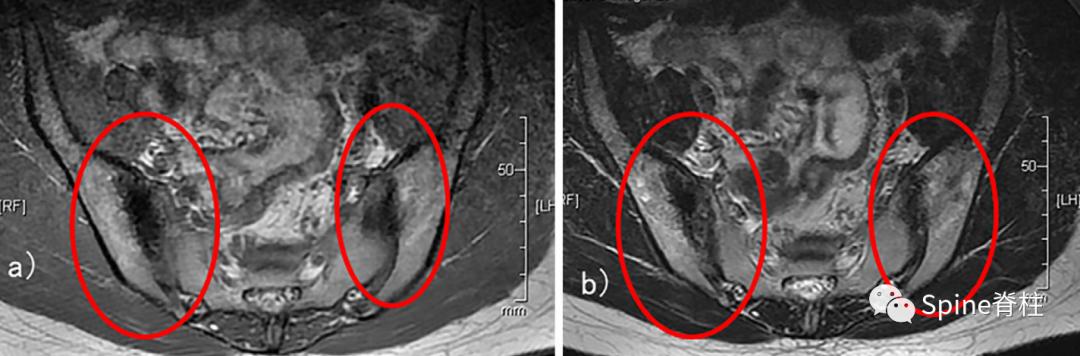 女性慢性腰痛谨防致密性髂骨炎,产后腰痛要做什么检查