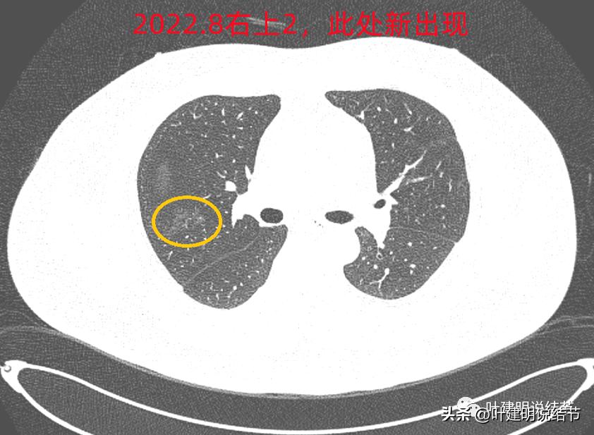 如何判断肺磨玻璃结节是高危结节,肺上有混合磨玻璃结节要注意什么