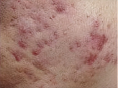 面部痘印中医治疗方案方子,脸上痘印中医的治疗方法